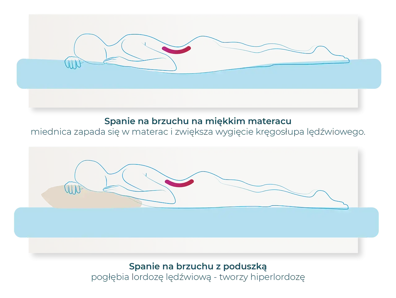 Ilustracja pokazuje, jak nieprawidłowa pozycja spania na brzuchu pogłębia lordozę lędźwiową. Prawidłowa pozycja spania jest kluczowa dla zdrowia kręgosłupa.